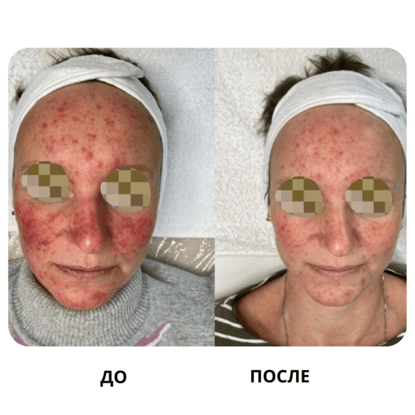 До и после: Акне, угревая болезнь
