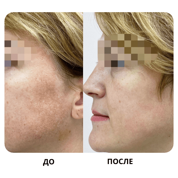 До и после: Гиперпигментация