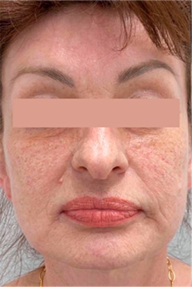 До процедуры ФДТ