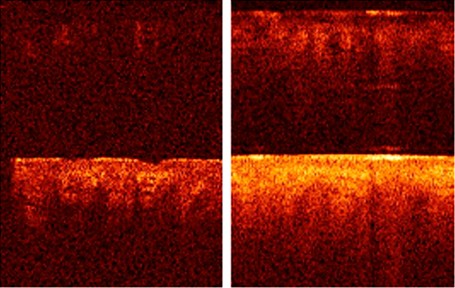 Динамика ОКТ-изображения — фотоомоложение, до и после курса ФДТ