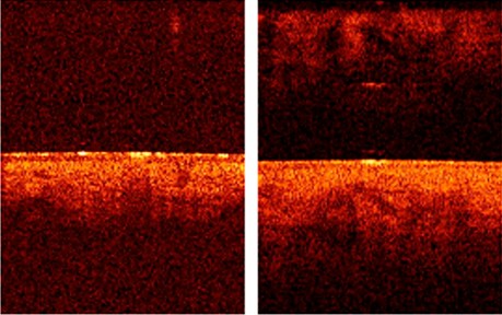 Динамика ОКТ-изображения — процедуры ФДТ с CHLODERM®, до и после курса